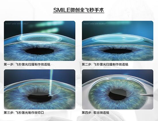 蔡司全飛秒、蔡司半飛秒近視手術(shù)與宇航飛秒的區(qū)別