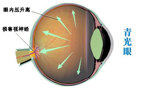 患青光眼為什么會(huì)失明?
